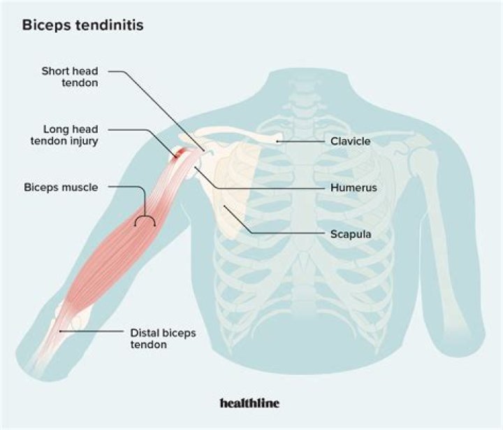 Biceps Muscle Injuries