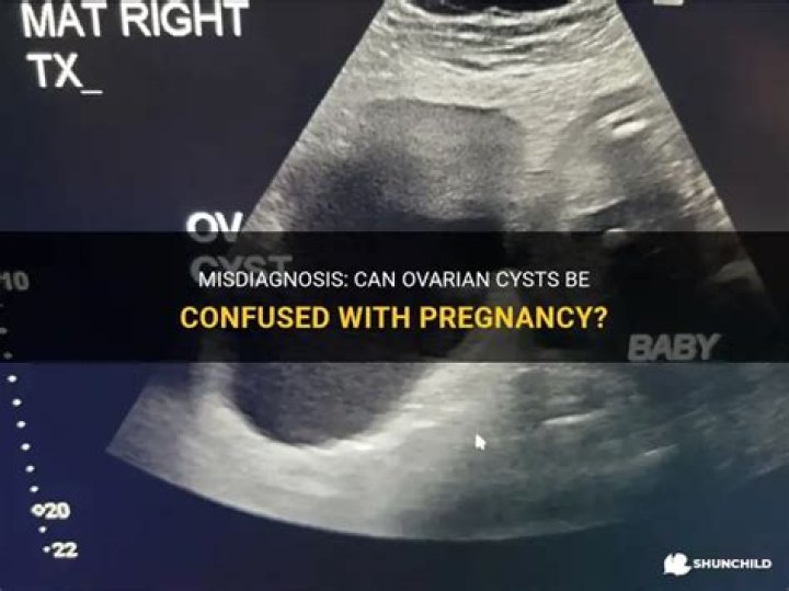 Can a cyst be confused with pregnancy?