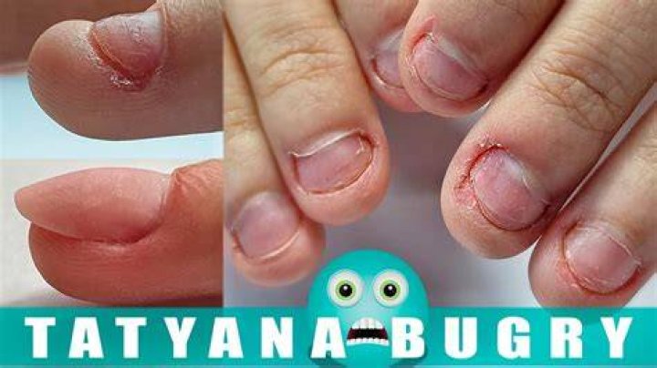 Can a manicure fix bitten nails?