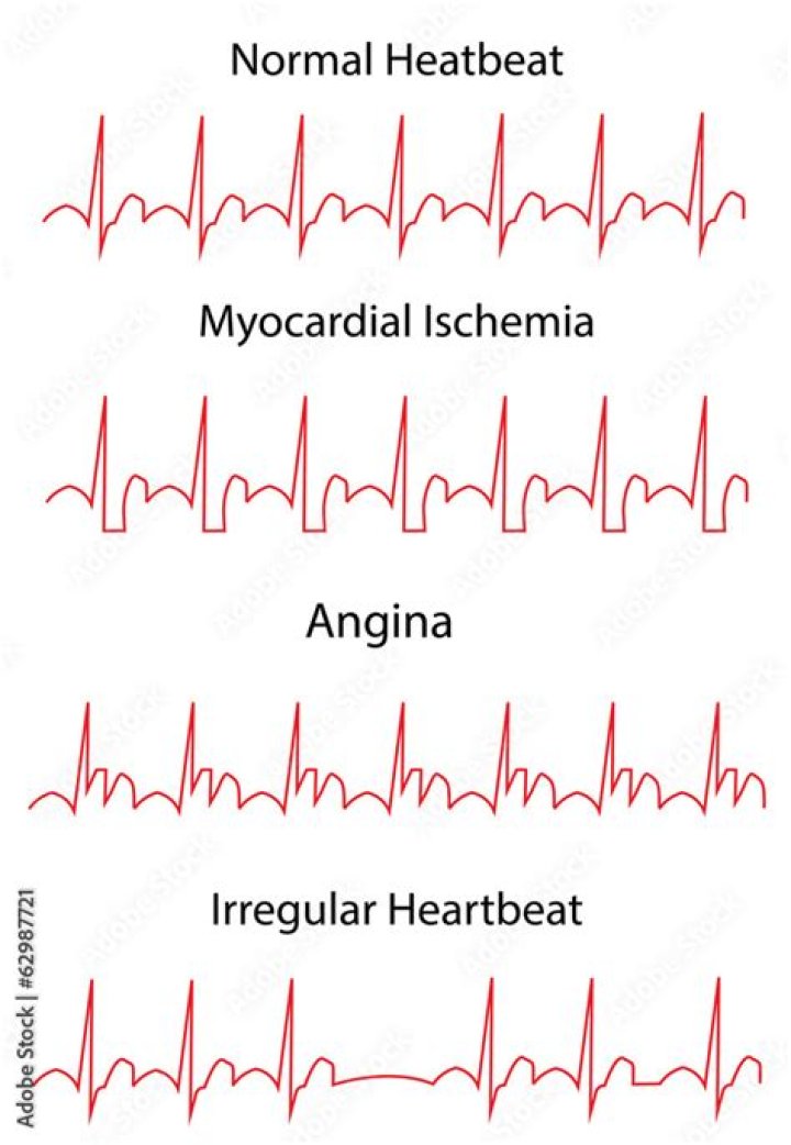 Can an ECG detect angina?
