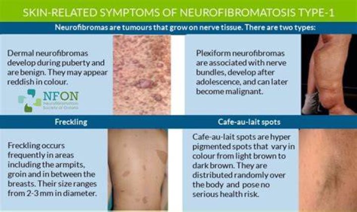 Can neurofibromatosis be prevented?