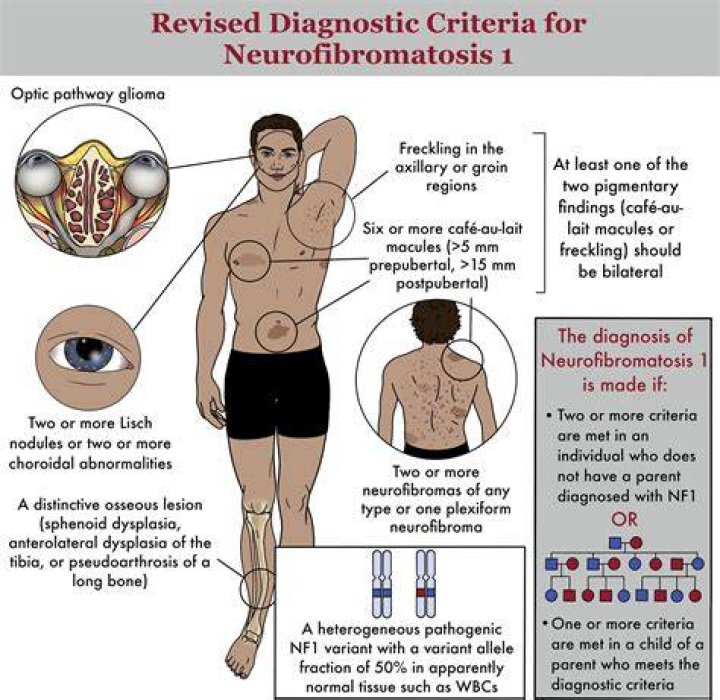 Can you get disability for neurofibromatosis?