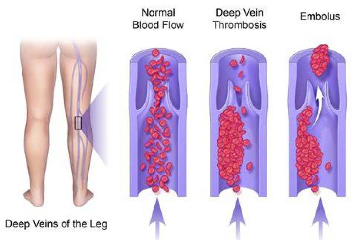 Deep Vein Thrombosis Dvt Symptoms Treatment Causes An vrogue.co