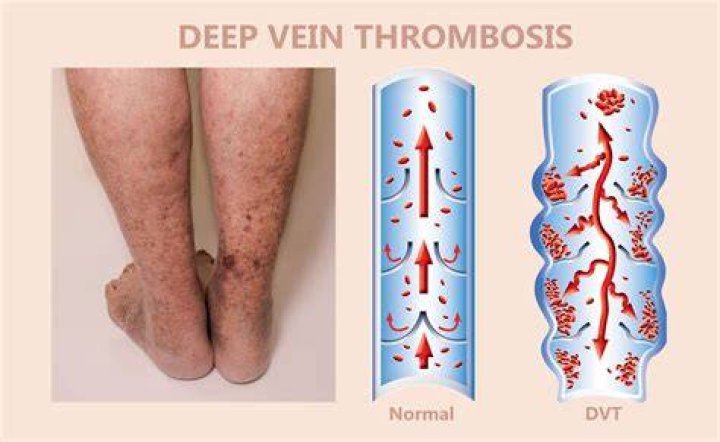 Deep Vein Thrombosis (DVT) Vein Specialist of the Carolinas
