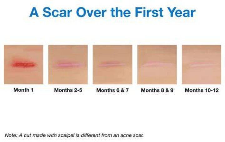 Do scars go away?