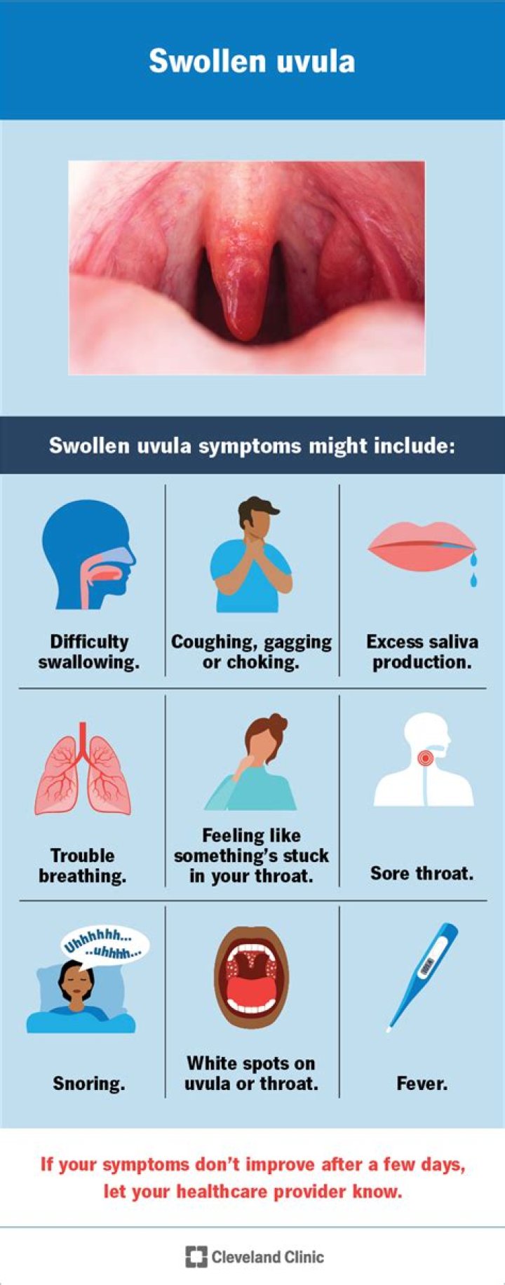 Do you need antibiotics for uvulitis?