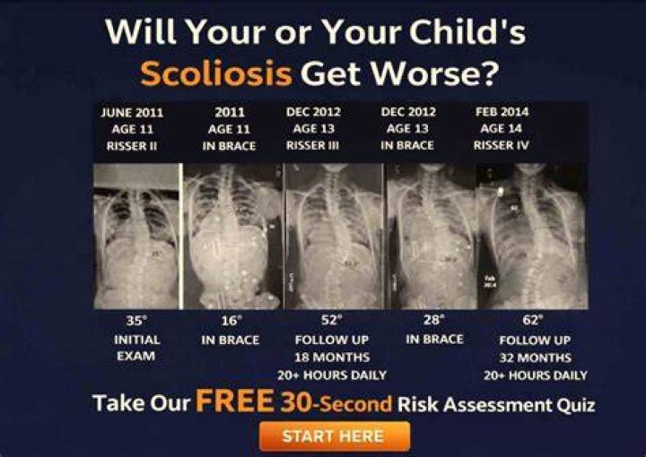Does Scoliosis Get Worse Over Time? Scoliosis SOS