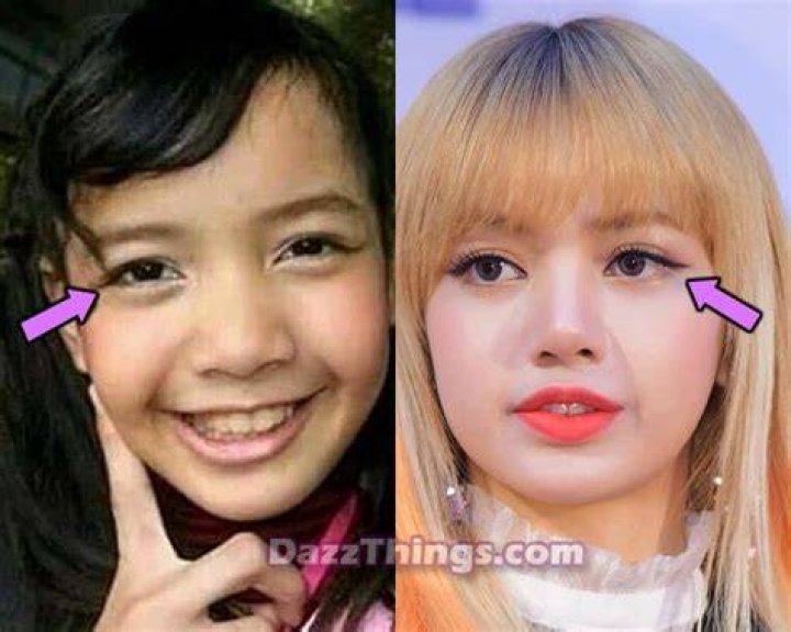 Has Lisa Had Plastic Surgery? Transformation Photos Life & Style