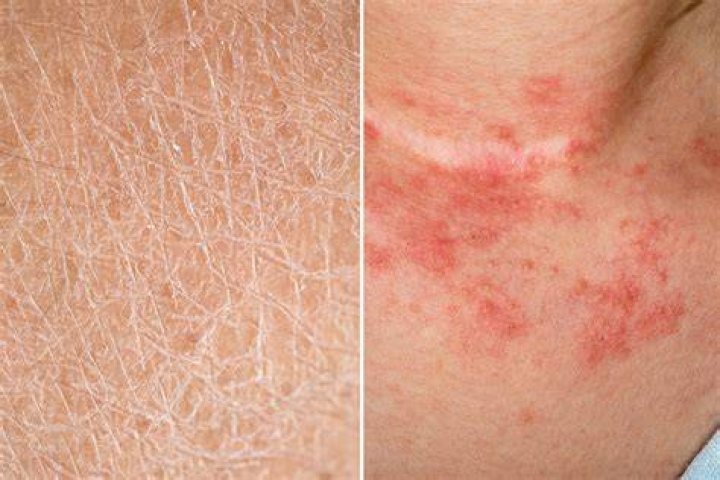 How do you detox for eczema?