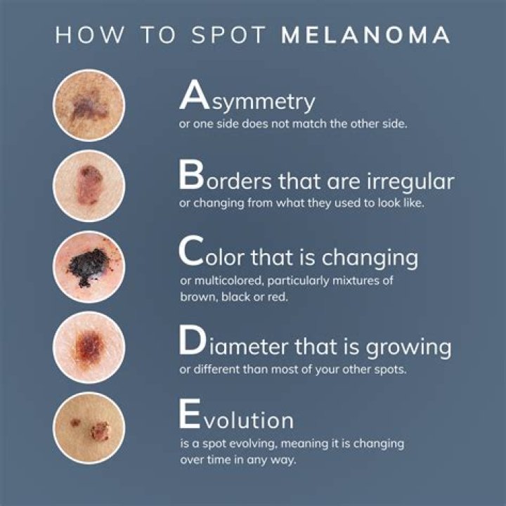 How do you know if melanoma has spread?
