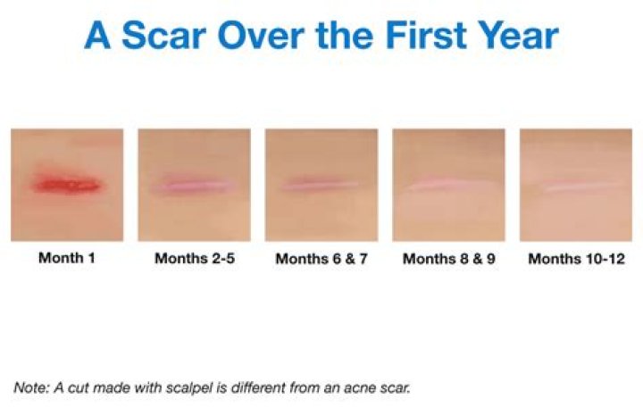 How long do small scars take to fade?