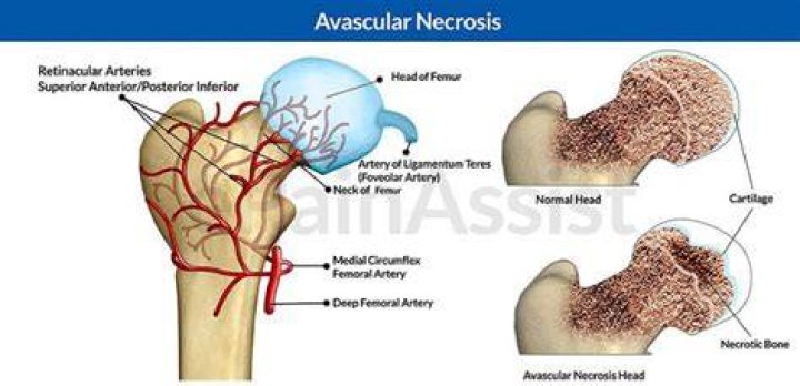 How long does it take for avascular necrosis to develop?