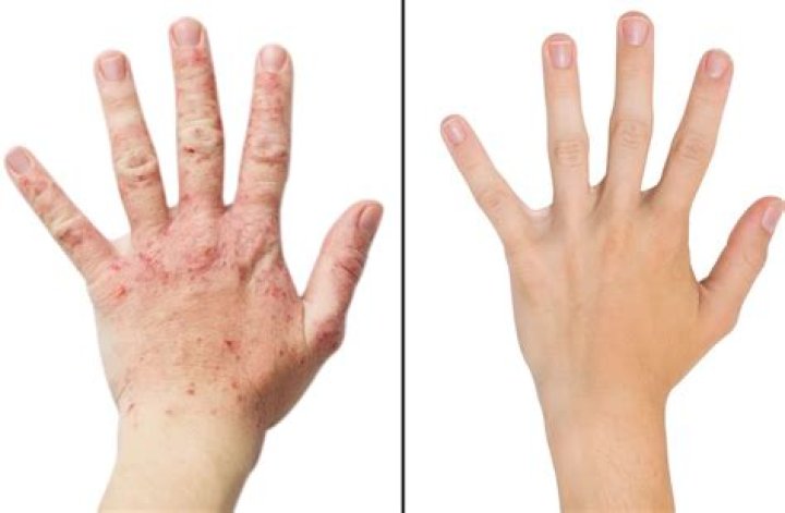 Is eczema worse in summer or winter?