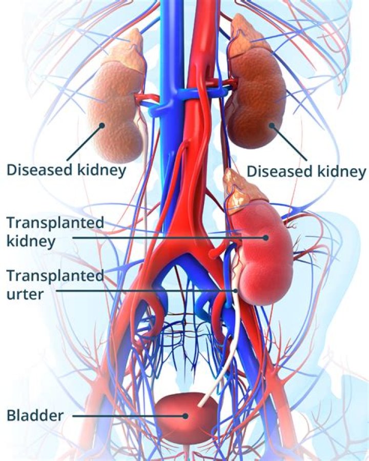Kidney transplants