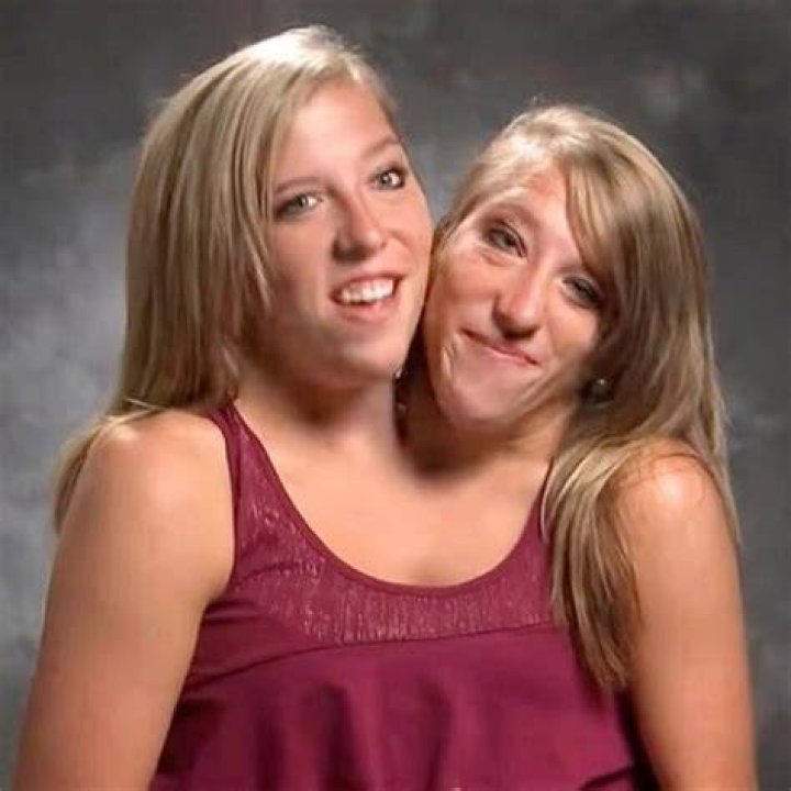 Life as conjoined twins 'You see the warmest of hearts, and you see
