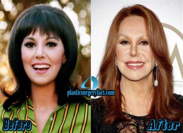 Marlo Thomas Plastic Surgery Before and After Photos Latest Plastic