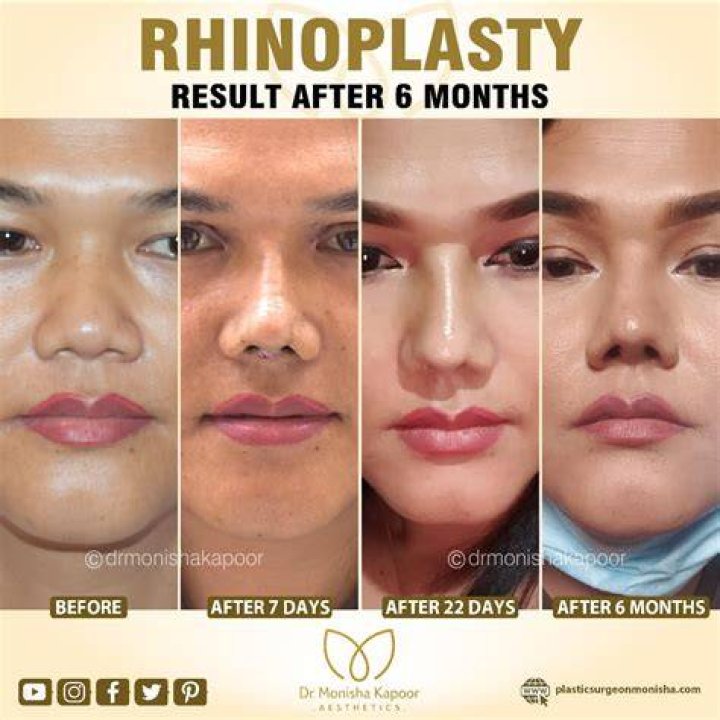 My Rhinoplasty Procedure Story &mdash; Nose Before and After Photos Allure