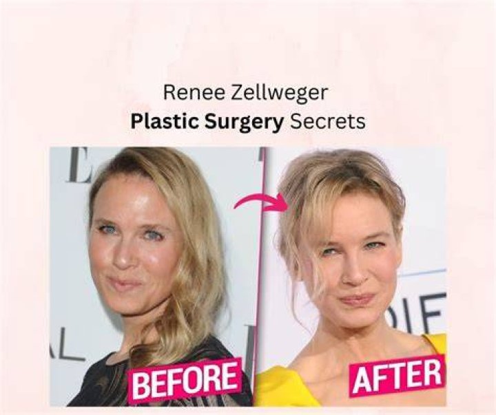 Renee Zellweger’s Possible Plastic Surgery Makeover Revealed Claim Top Docs