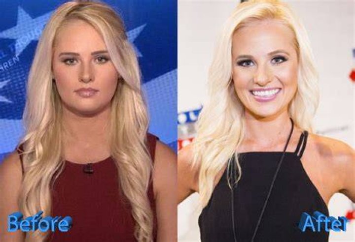 Tomi Lahren Before And After Plastic Surgery