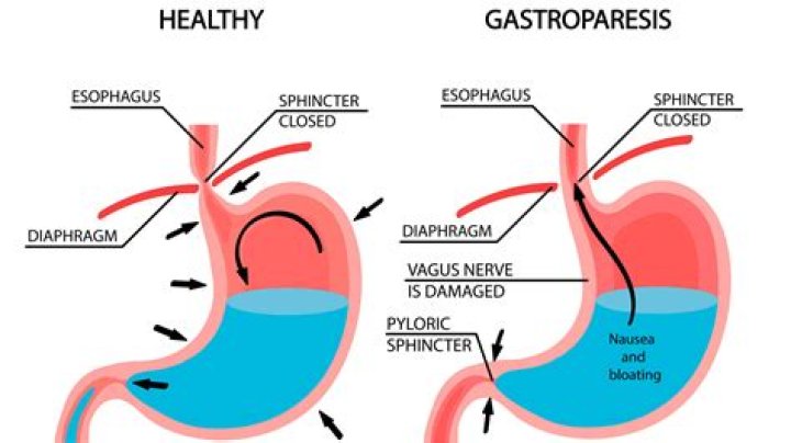 What are the symptoms of stomach paralysis?
