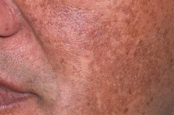 What does hyperpigmentation look like on the face?