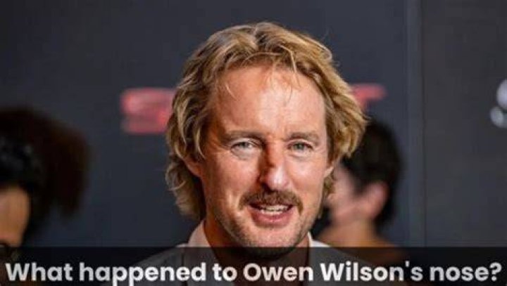 What Happened To Owen Wilson&rsquo;s Nose? Here&rsquo;s How It Looked Before