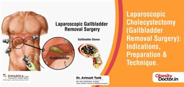 What happens if you wait to get your gallbladder removed?
