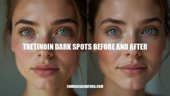 Which tretinoin is best for dark spots?