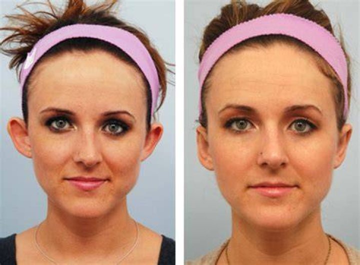 Why do I have to wear a headband after otoplasty?