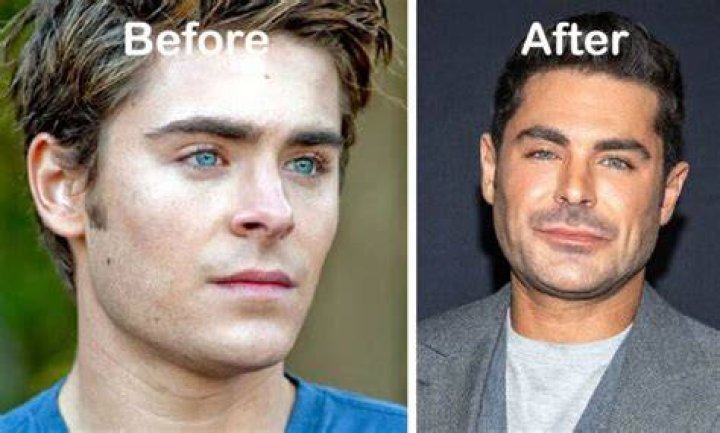Zac Efron Before and After Has He Had Any Plastic Surgery? Zac efron