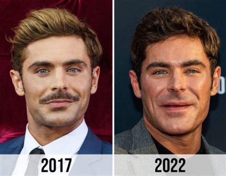 Zac Efron Broken Jaw Why Does He Look Different Promoting 'Iron Claw'?