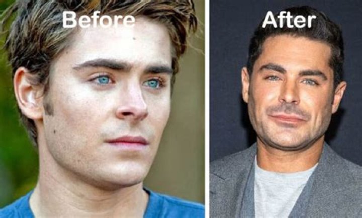 Zac Efron jaw injury explored as Baywatch star opens up on what caused