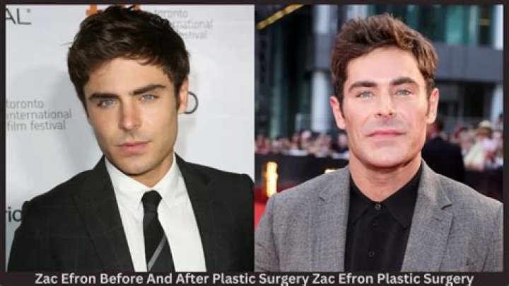 Zac Efron Plastic Surgery Video Before & After Photos In 2022 Has He